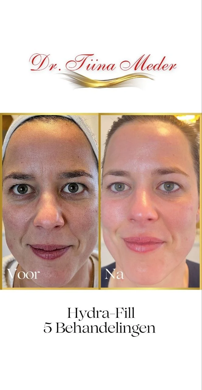 Voor en na resultaat Dr. Meder behandeling bij RA Beauty 5