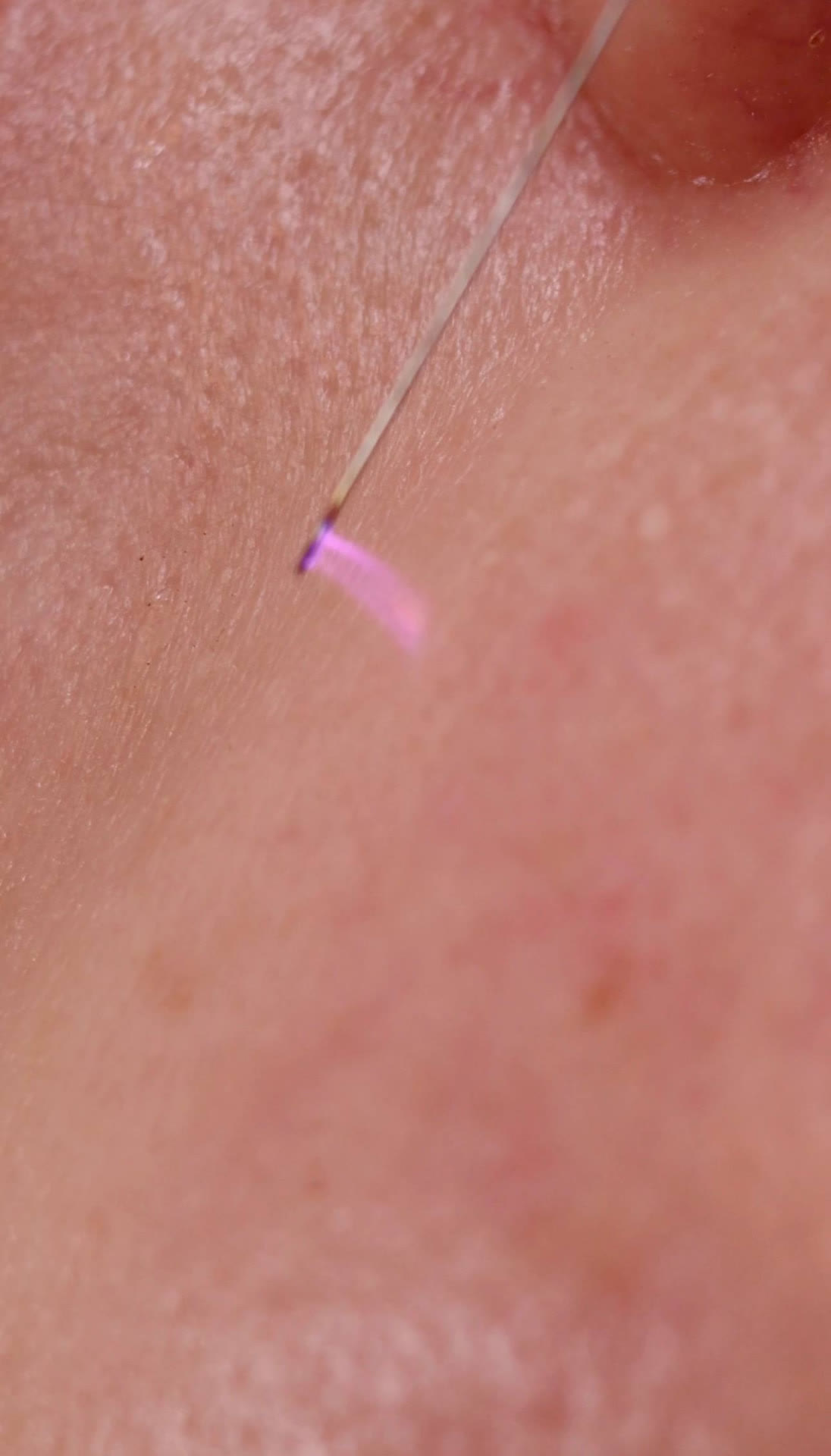 Detail van de Cold Plasma boog op de huid bij RA Beauty Antwerpen